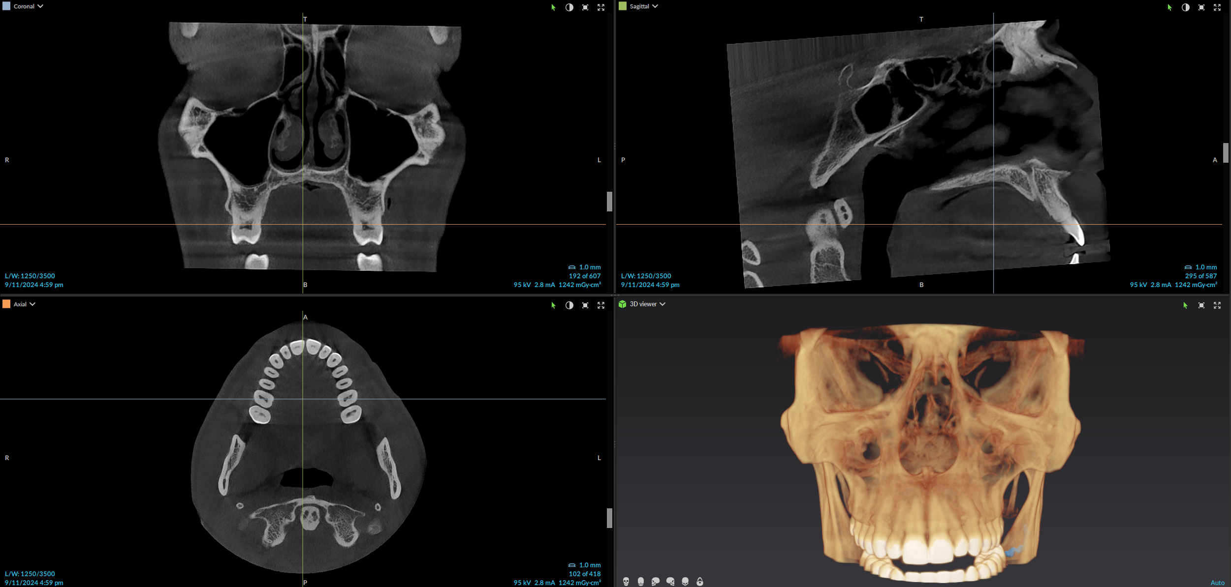 CBCT 3-D scan showing coronal, sagittal, axial, and 3-D rendered views of the jaw and skull