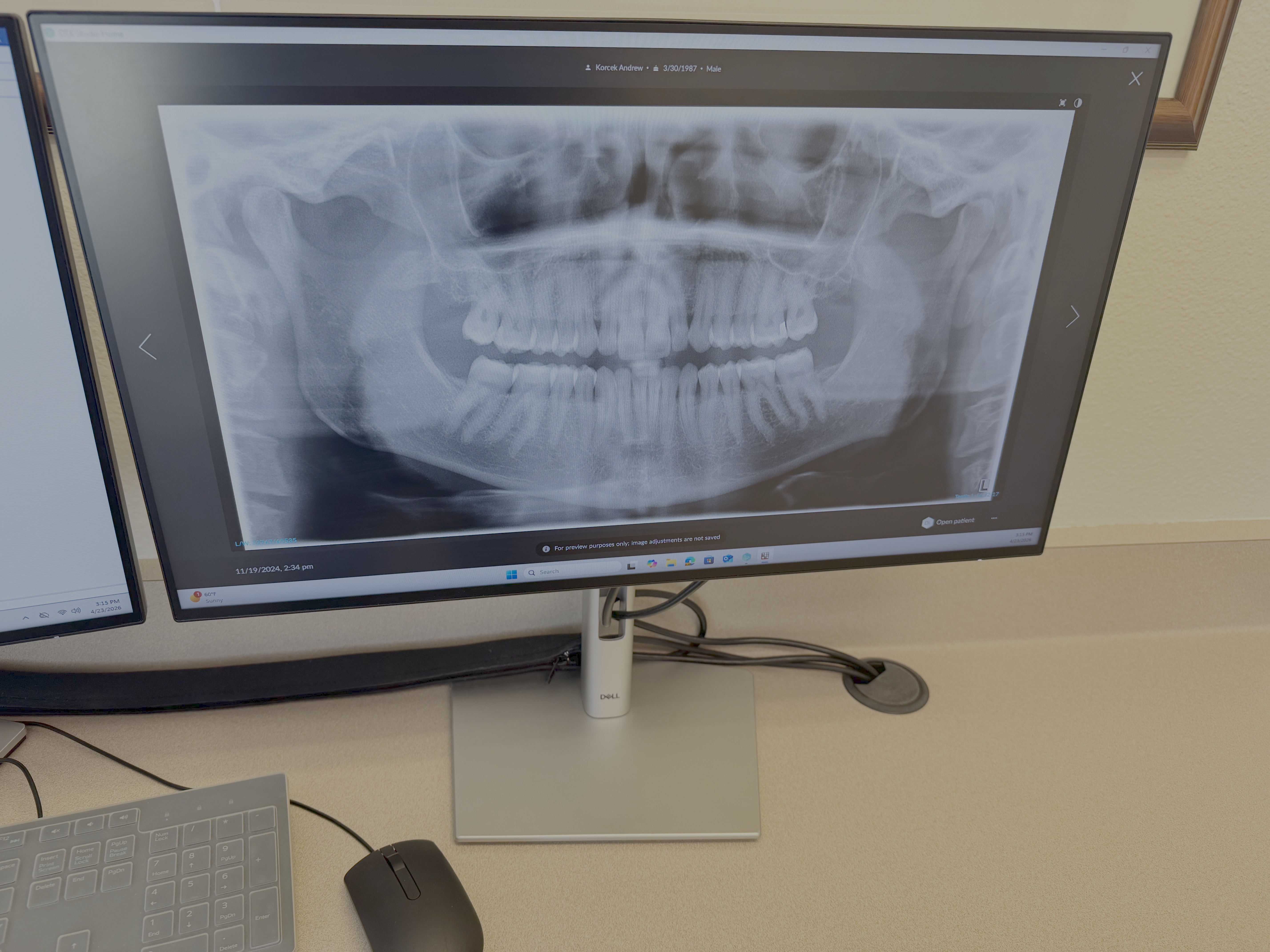 Digital panoramic X-ray displayed on monitor in Korcek Dental treatment room