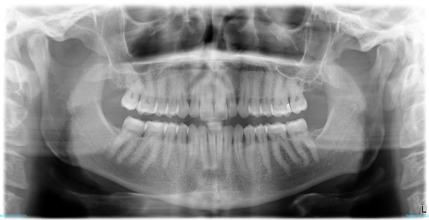 Detailed panoramic dental X-ray showing full upper and lower arch